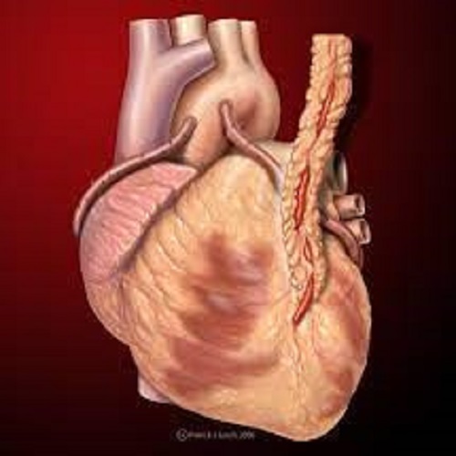 CABG - Bypass Heart Surgery in India for Foreign Patients.